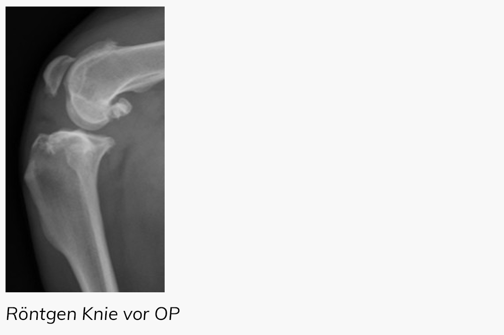 Röntgenbild eines Knies vor der Operation
